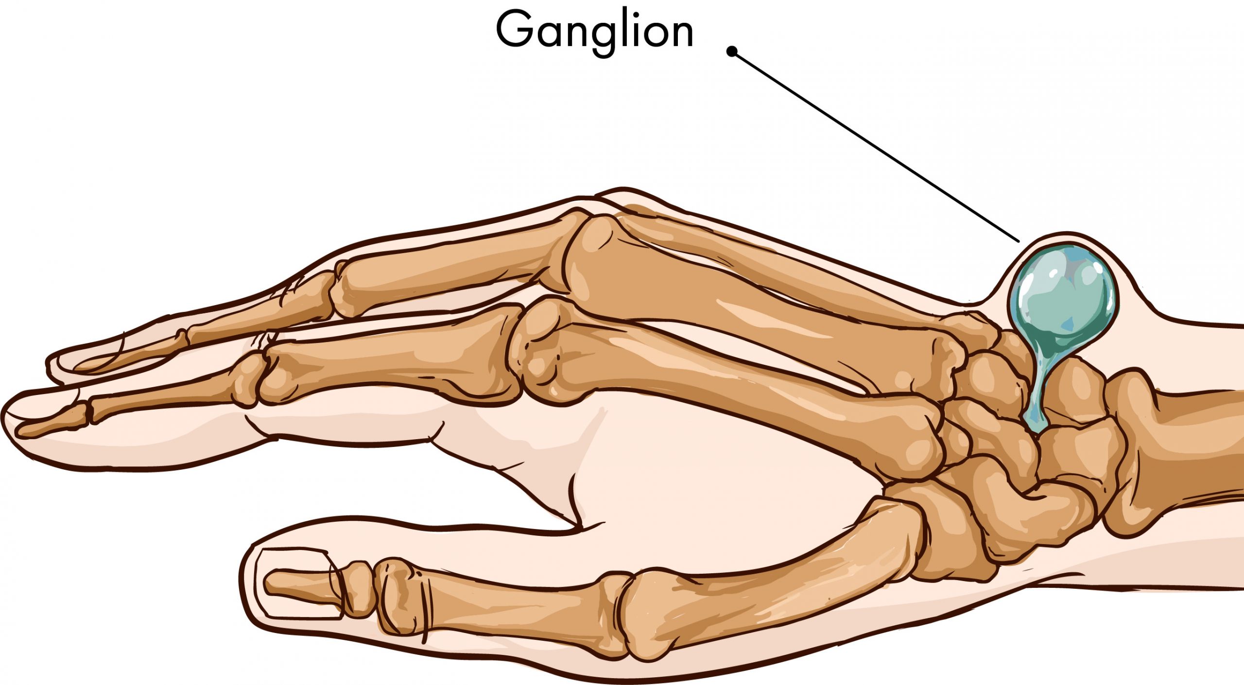 Ганглион мкб. Гигрома лучезапястного сустава мкб. Гигрома лучезапястного сустава анатомия. Синовиальная киста (гигрома).