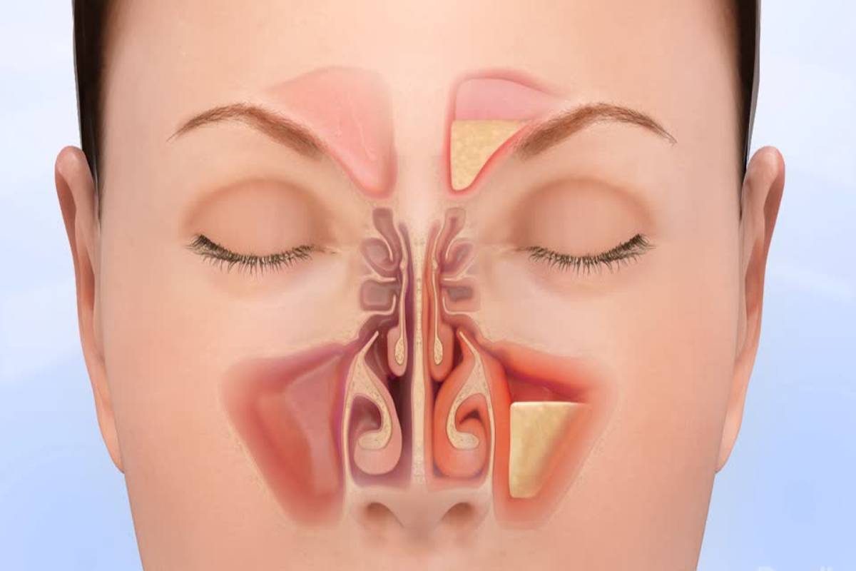 Заложенность носа и 5. Вазомоторный ринит септопластика.
