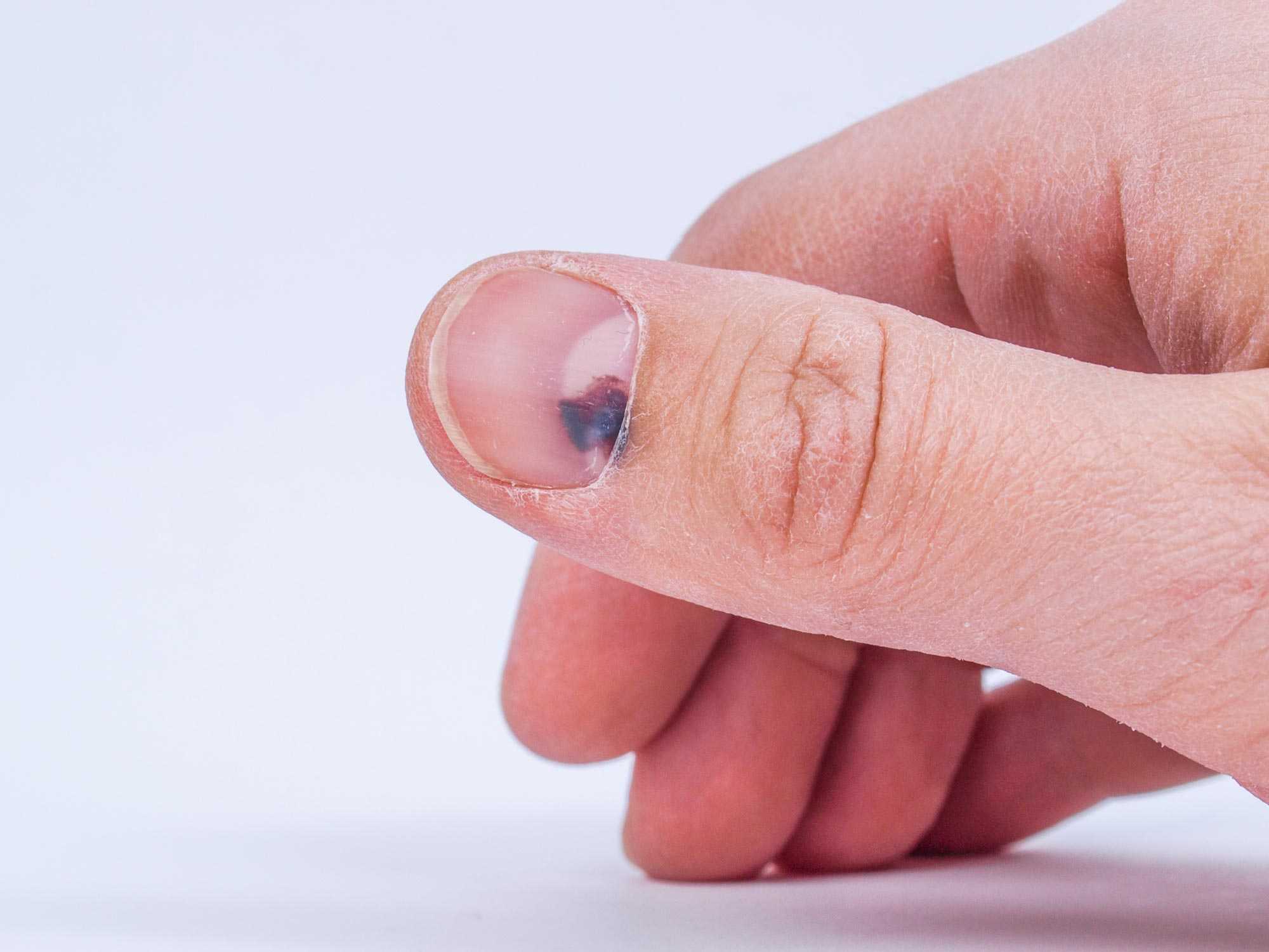 Пальцы колет иголками. Подногтевая гематома дерматоскопически. Кровоизлияние под ногтем.