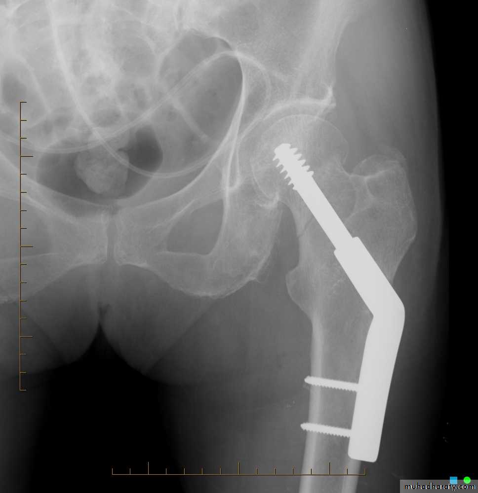 Перелом бедра. Перелом хирургической шейки бедра рентген. Остеосинтез бедра рентген. Перелом шейки бедра остеосинтез рентген. Оскольчатый перелом шейки бедра рентген.