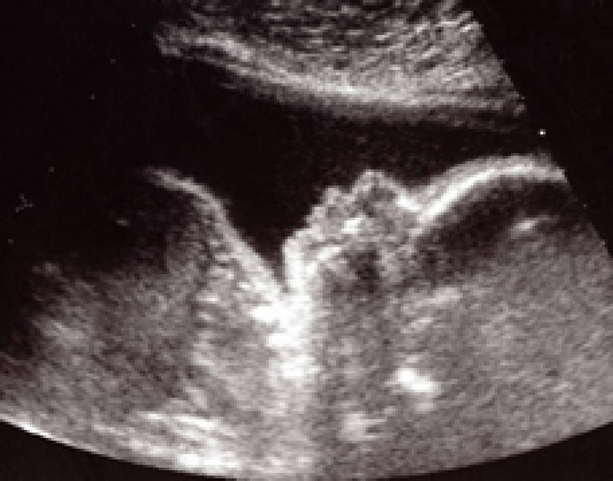 25 неделя 2023. Nose of fetus on Ultrasound.