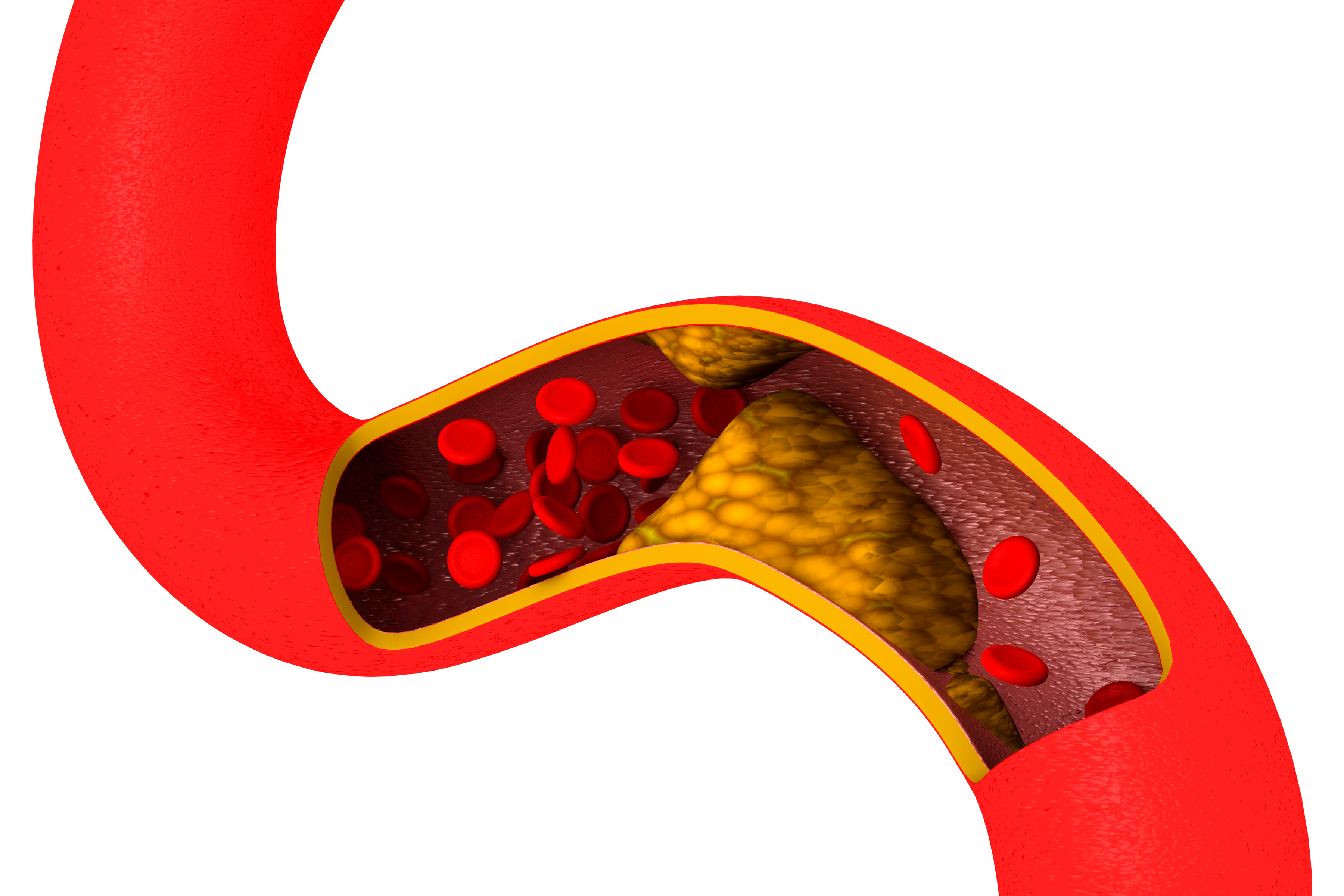 Cholesterol. Наследственная гиперхолестеринемия. Семейная гиперхолестеринемия. Атеросклероз.. Гиперхолестеринемия фон. Наследственная гиперлипидемия.