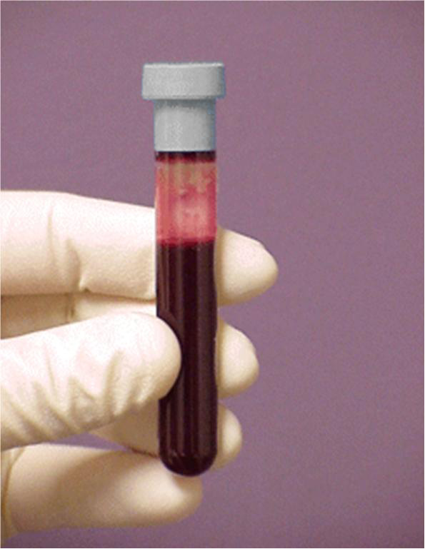 Препарат крови тест. Венозная кровь в пробирке. Билирубин в пробирке. Анализ крови фото. Пробирки с кровью ИФА.