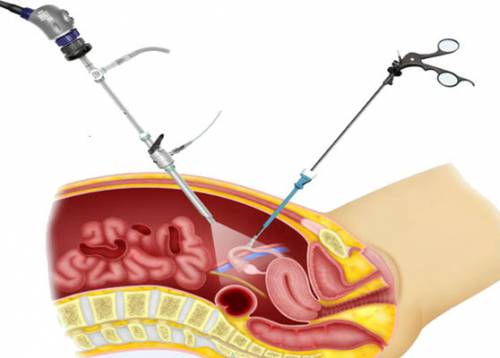 Матки лапароскопическим. Клиновидная резекция яичников лапароскопия. Лапароскопическая овариоэктомия. Лапароскопия пункция яичников. Апоплексия лапароскопия.