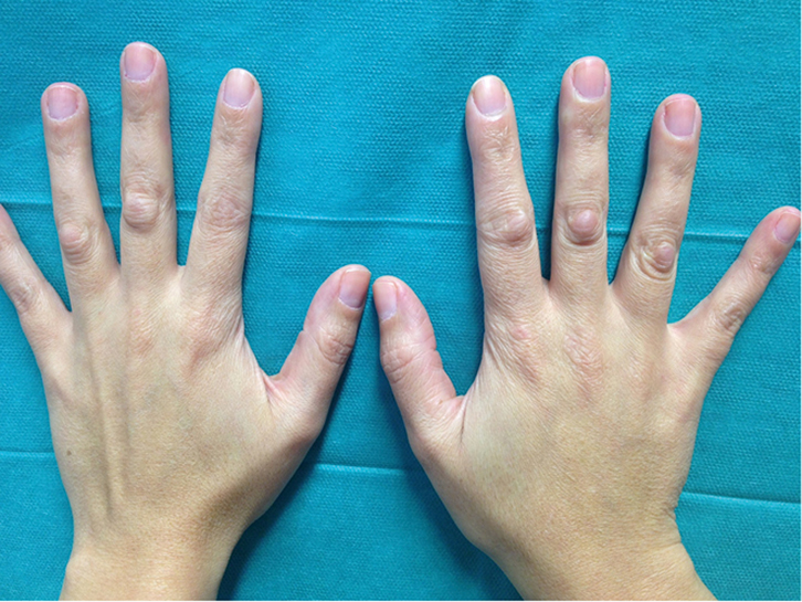 middle-joint-of-finger-swollen-15-causes-of-swollen-fingers