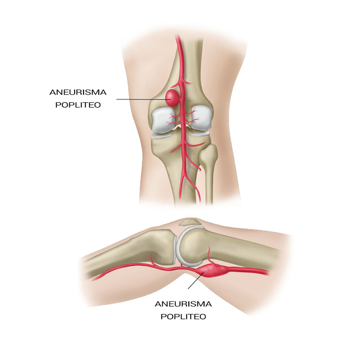 Подколенная артерия. Аневризма подколенной вены. Аневризма коленной артерии. Аневризм подколенной артерии. Сустав колена болит сбоку внутренней стороны.