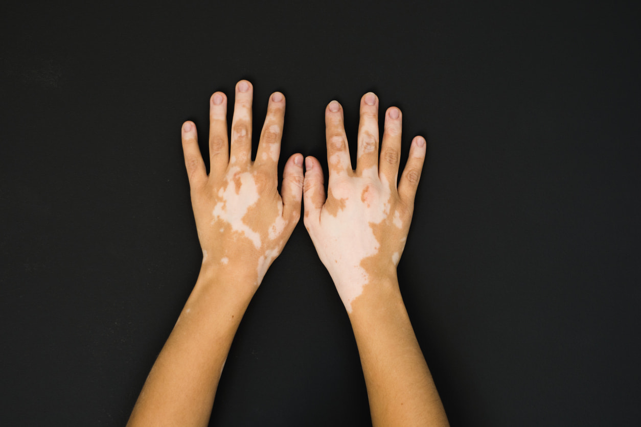 Bubbles On Hands Rash Dyshidrosis Symptoms And Causes