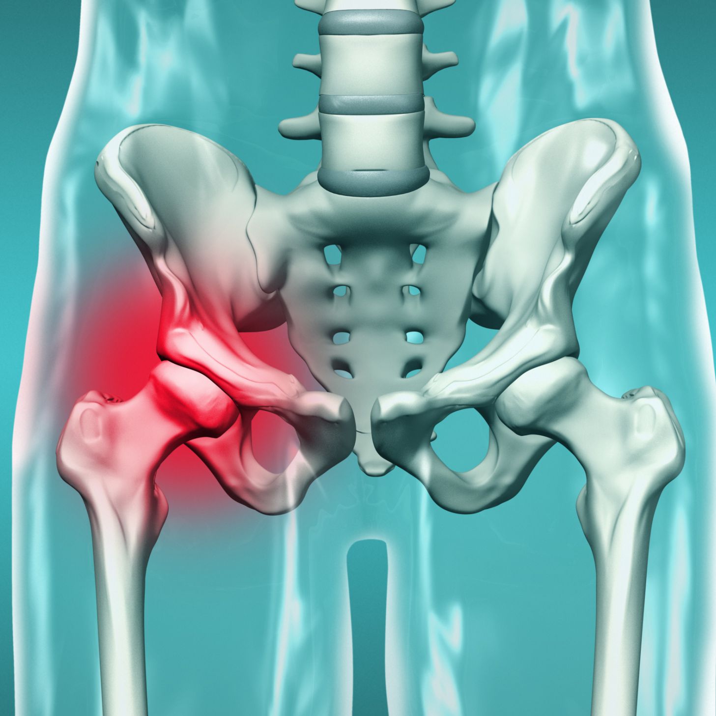 Тазобедренный сустав операция показать. Люмбалгия тазобедренного сустава. Тазобедренный сустав Hip. Синостоз тазобедренного сустава.
