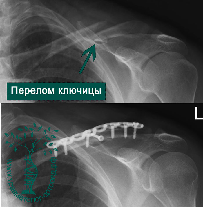 Перелом ключицы как долго. Периимплантный перелом ключицы.