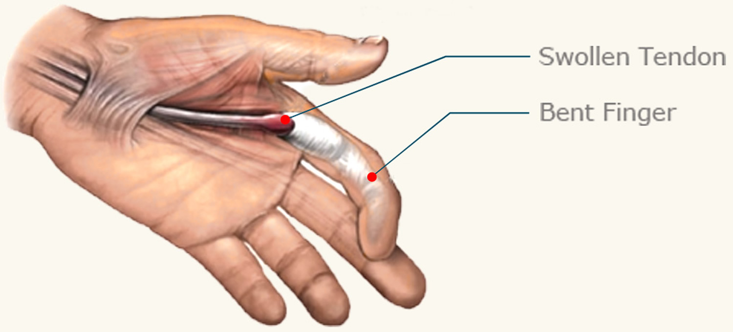 Тендинит сухожилия пальца